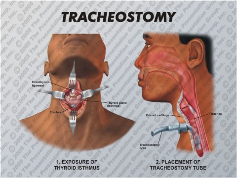 tracheostomy tube tracheotomy speech nursing after anatomy surgical ventilator diagram speaking therapy medical regaining respiratory order different give done fair