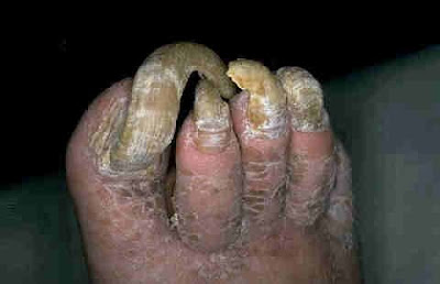 ugly+feet.bmp