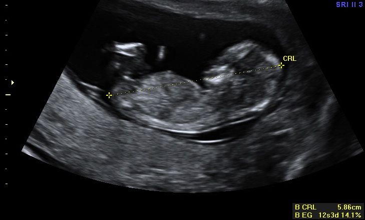 el sexo del bebe