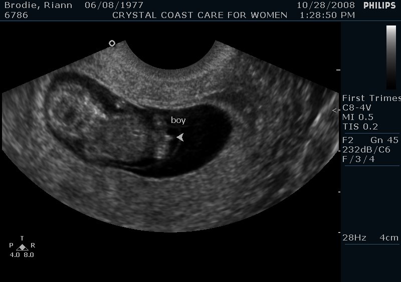 Curve ball at 10 weeks in Ultrasound Gender Prediction Forum
