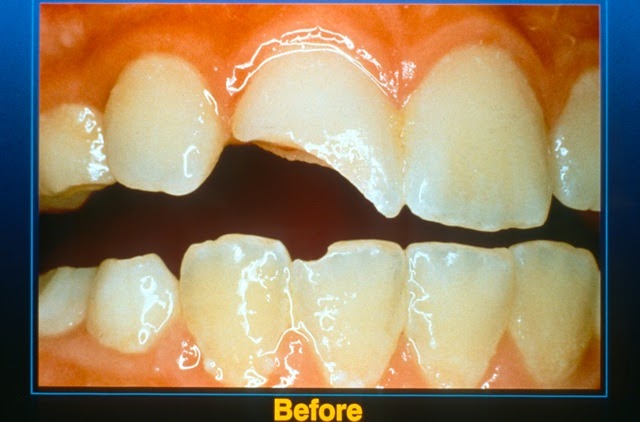 Pediatric Dentistry: Broken tooth