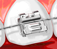 การจัดฟันแบบใหม่ด้วยระบบดามอน (Damon™ System)