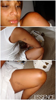 cyst facial swelling nude girl gif photo