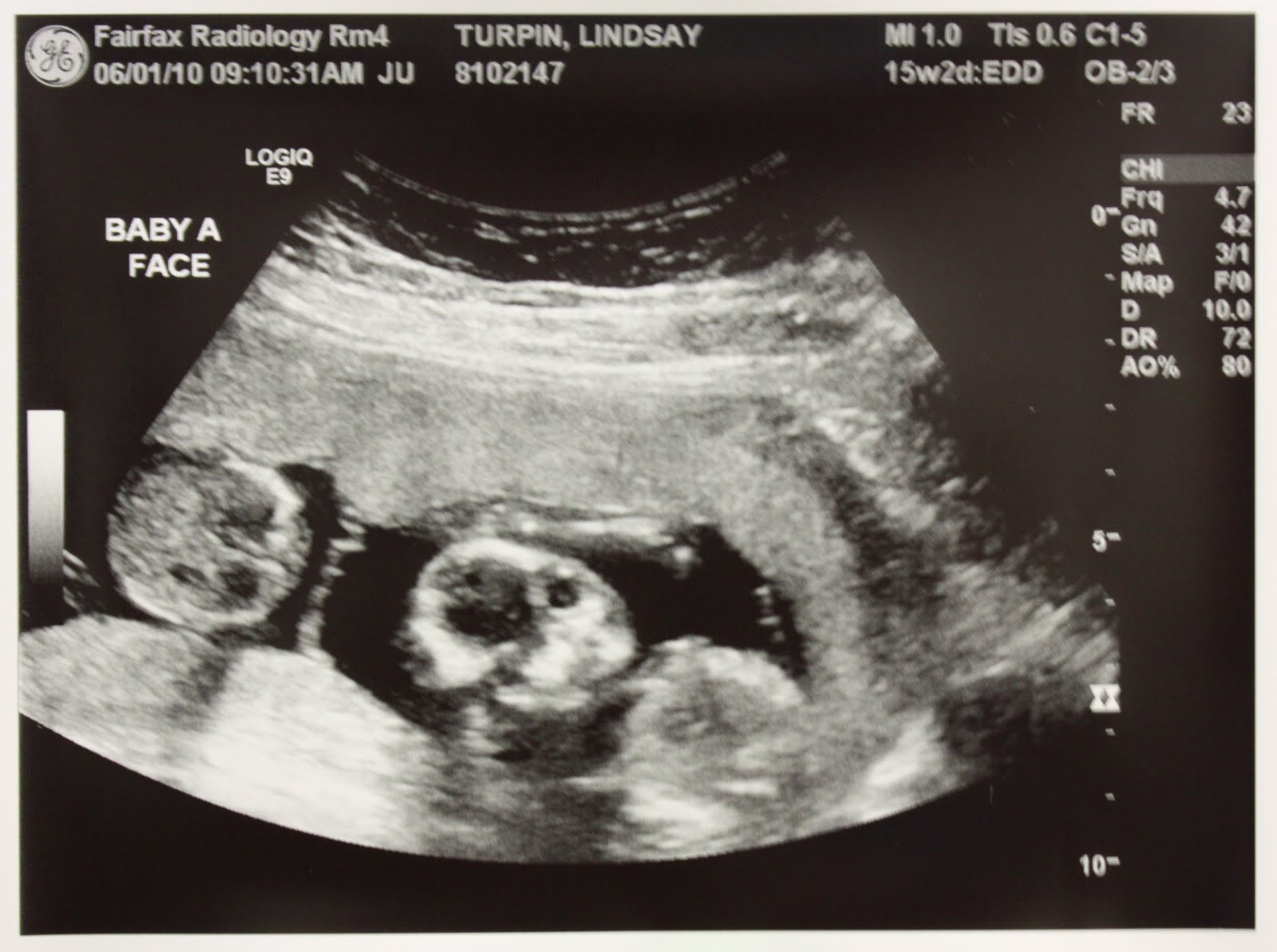 Adventures in Baby Making 16 Weeks Ultrasound Pics