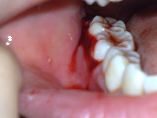 wisdom stitches tooth bottom plucking 2nd much blood
