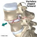 Lumbar Spondylolisthesis: Usually involves slippage of the fifth lumbar vertebra over the top of the sacrum