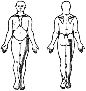 A lumbar radiculopathy may cause pain into the leg along with numbness and tingling