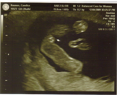 When can babies sex be determined by ultrasound