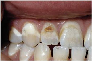 Cosmetic Dentistry, enamel demineralization remedies, dental treatment