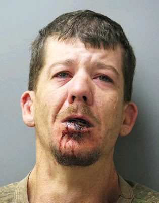 Injured Lip