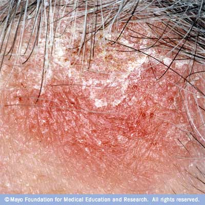 [seb_dermatitis.jpg]