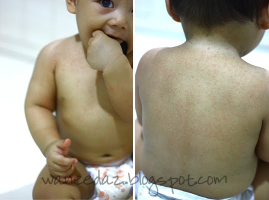 heat rash on baby skin. Heat rash happens when the