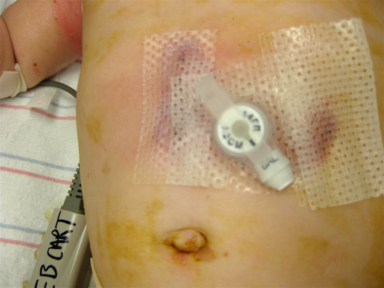 anchor incision
