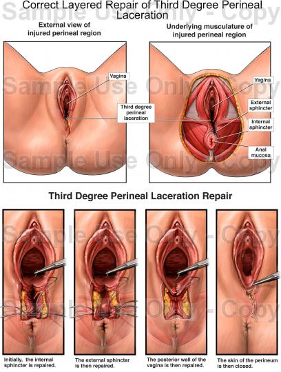 LESIONES PERINEALES