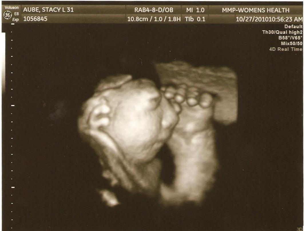 Anencephaly+Ultrasound+Pictures The sonographer thought that my placenta and cord were showing on the ...