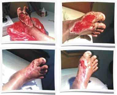 ASUHAN KEPERAWATAN: SOP PERAWATAN LUKA