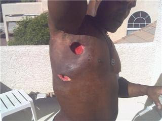 Kevin+Randleman+Staph+Recovery2.jpg