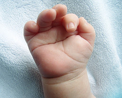 Cri Du Chat Signs And Symptoms | RM. Cri Du Chat Signs And Symptoms | RM.