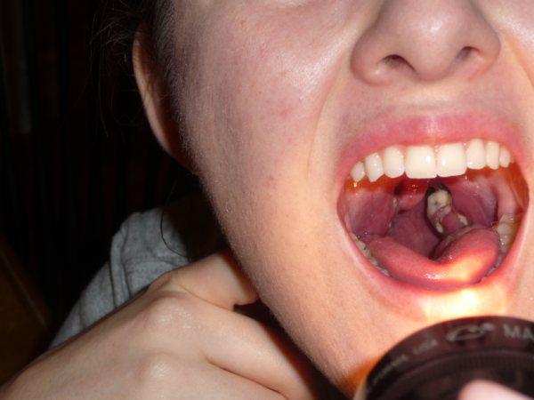 mono tonsils