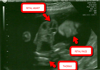 Dating scan ob gyn