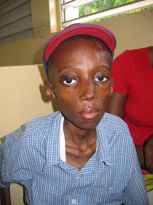 Aids Patients Pictures