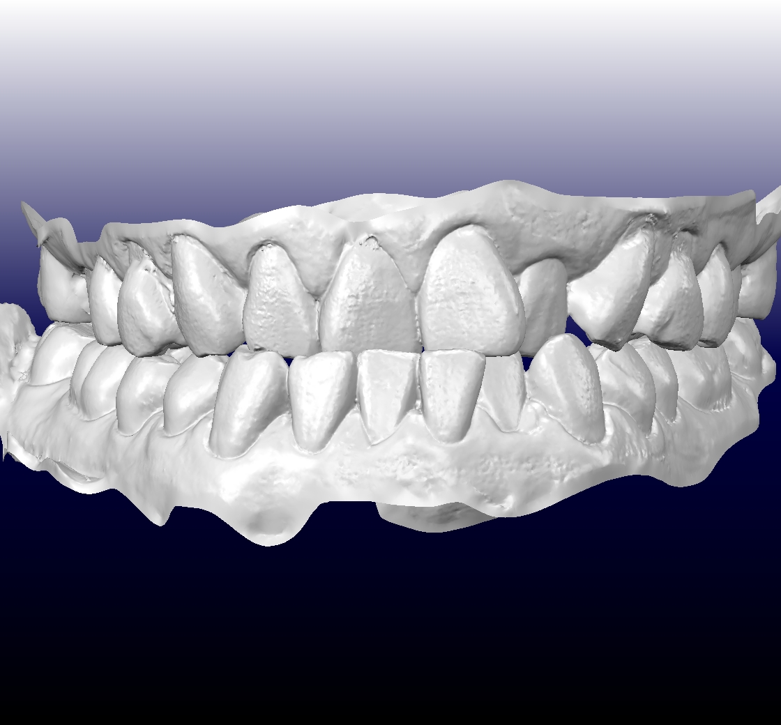 Tooth Size Discrepancy