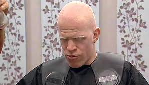 bald+albino.jpg