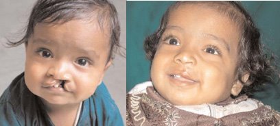 [cleft_repair.jpg]