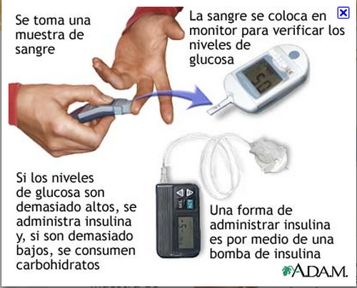 Diabetes lucha diaria: ¿Sube tu nivel de glucosa Diabetes lucha diaria: ¿Sube tu nivel de glucosa