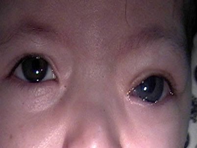 oscilacion espasmodica del globo ocular enfermedades de los ojos glaucoma congenito en los ni 241 os oscilacion espasmodica del globo ocular enfermedades de los ojos glaucoma congenito en los ni 241 os