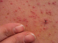 Steroid Folliculitis