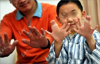 มนุษย์ปลาหมึก? พบเด็ก 31 นิ้วที่จีน