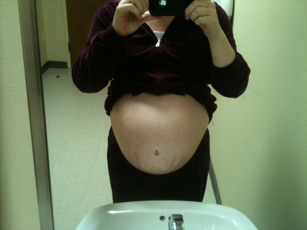 Belly Button Keloids