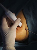  Ultrasound Guided Core Needle Biposy