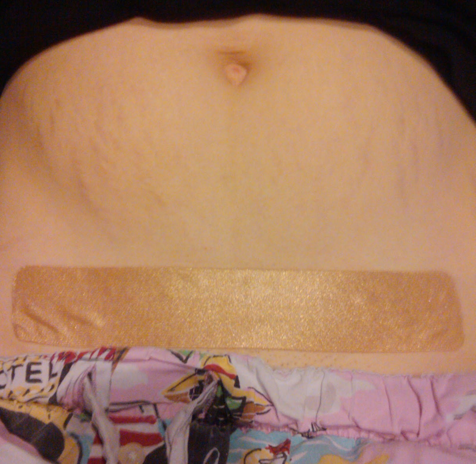 healing the scars scaraway c section scar treatment strips scaraway sheets review