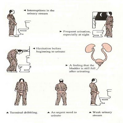 [symptoms+of+bph.bmp]