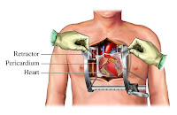 http://4.bp.blogspot.com/_zjr9tzdob1k/TUn4lnrUfAI/AAAAAAAAAgE/ekm2J3gt9Xk/s1600/bedah+jantung.jpg