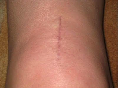 Knee Scar Tissue