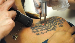 Tattoo Removal In a Natural Way