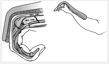 Lesdoup: Closed Reduction, Casting, and Traction