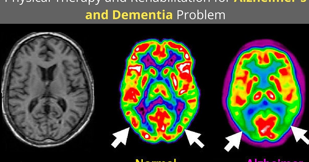 Physical Therapy Blog By Prakash Shah Physical Therapy and Rehabilitation for Alzheimer's and