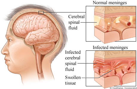 Mengenal Lebih Jauh Tentang Penyakit Meningitis Mengenal Lebih Jauh Tentang Penyakit Meningitis