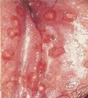 Cara Mengobati Bintik Bintik di Vagina Terasa Sakit dan Perih Secara Alami Sampai Tuntas Cara Mengobati Bintik Bintik di Vagina Terasa Sakit dan Perih Secara Alami Sampai Tuntas