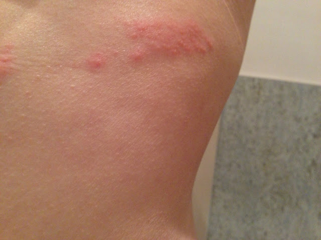 Bloop Blooop Bleeeeeep: Shingles - It starts with an itch...