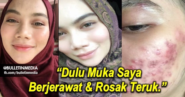 Siapa Yang Ada Jerawat, Korang Wajib Baca Ni ! Kalau Tak Korang Memang