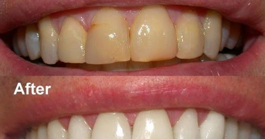 penyebab dan cara mengatasi gigi kuning