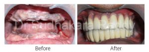 http://www.implantdentistindia.com/before-after-image-gallery.html