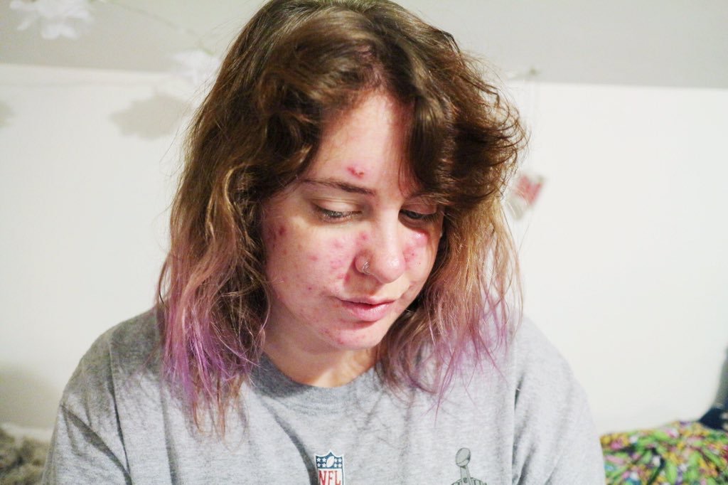 Cystic acne Cystic acne