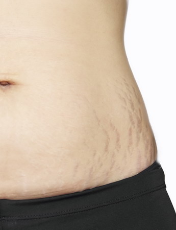 Phyllia 6281271241234 Cara Menghilangkan Selulit Setelah Melahirkan Cara Menghilangkan Selulit Alami Cara Menghilangkan Selulit Atau Stretch Mark