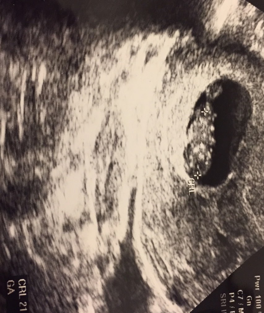 9 Haftalık Gebelik Ultrason Görüntüleri, Anne, Bebek